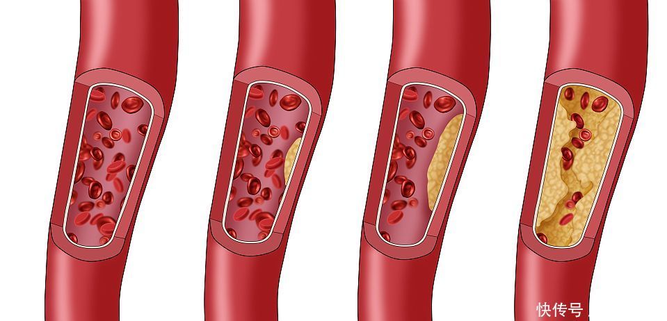 血脂高如何降低血脂