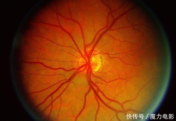 血脂高如何降低血脂